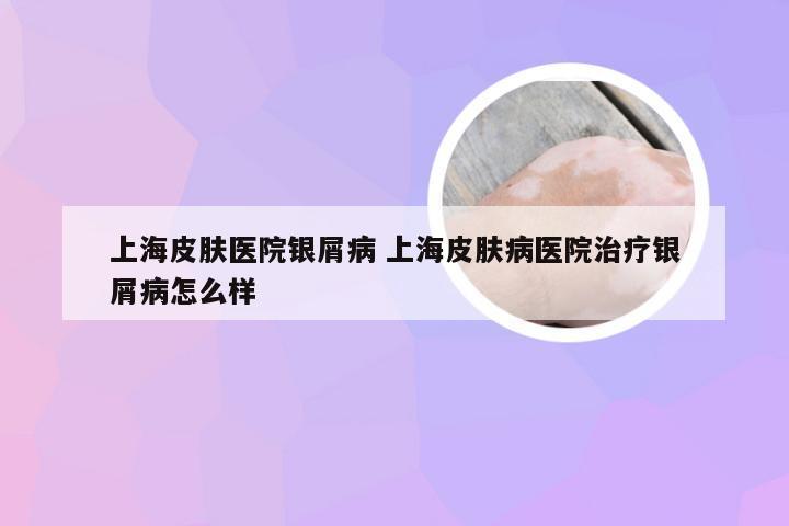 上海皮肤医院银屑病 上海皮肤病医院治疗银屑病怎么样