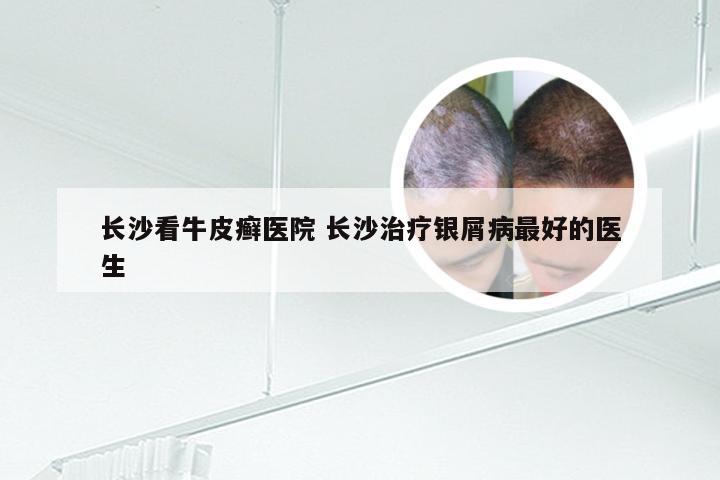 长沙看牛皮癣医院 长沙治疗银屑病最好的医生