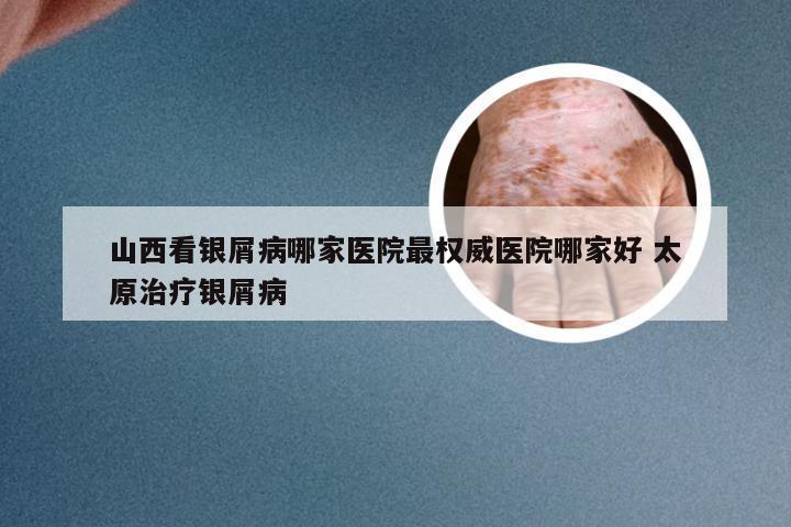 山西看银屑病哪家医院最权威医院哪家好 太原治疗银屑病