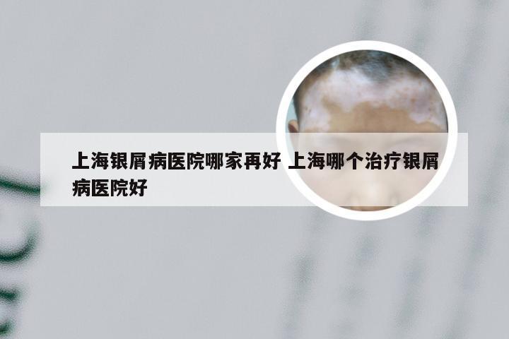 上海银屑病医院哪家再好 上海哪个治疗银屑病医院好