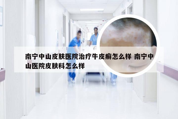 南宁中山皮肤医院治疗牛皮癣怎么样 南宁中山医院皮肤科怎么样