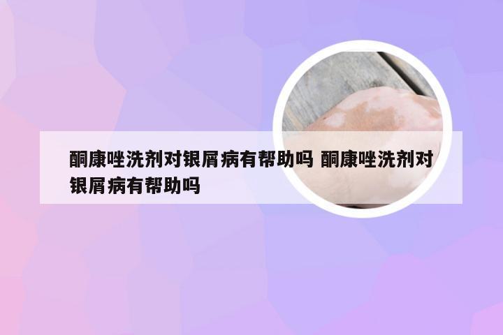酮康唑洗剂对银屑病有帮助吗 酮康唑洗剂对银屑病有帮助吗
