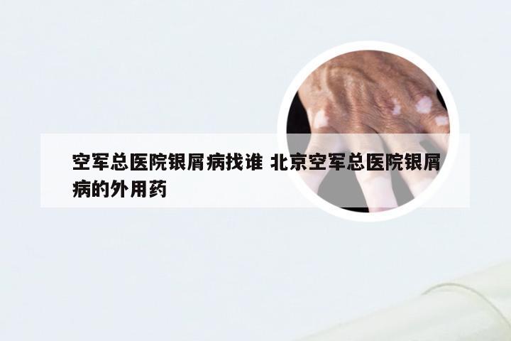 空军总医院银屑病找谁 北京空军总医院银屑病的外用药