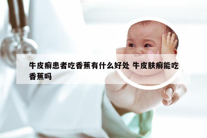 牛皮癣患者吃香蕉有什么好处 牛皮肤癣能吃香蕉吗