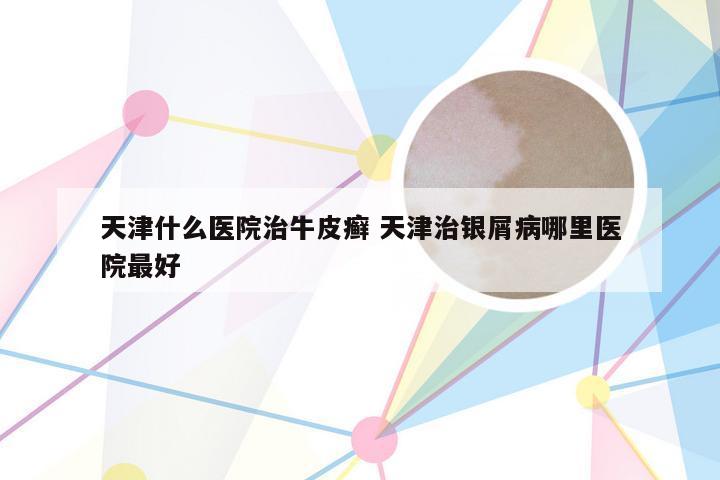 天津什么医院治牛皮癣 天津治银屑病哪里医院最好