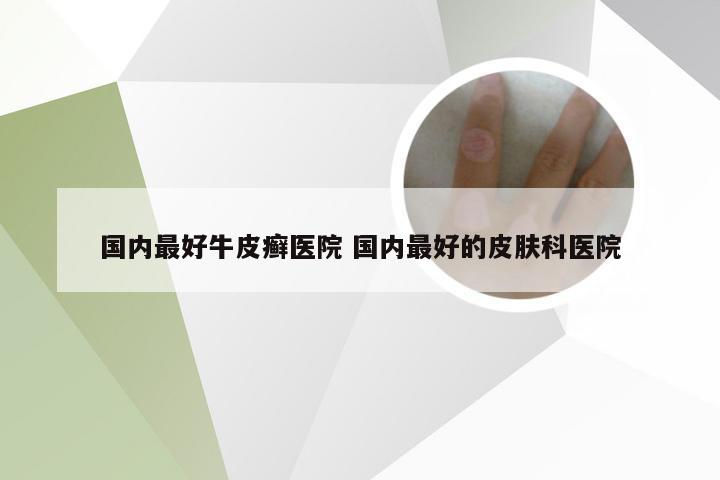 国内最好牛皮癣医院 国内最好的皮肤科医院