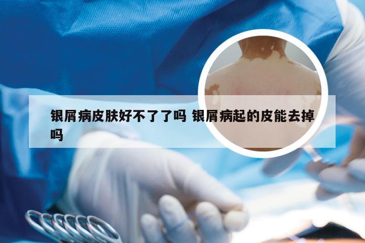 银屑病皮肤好不了了吗 银屑病起的皮能去掉吗