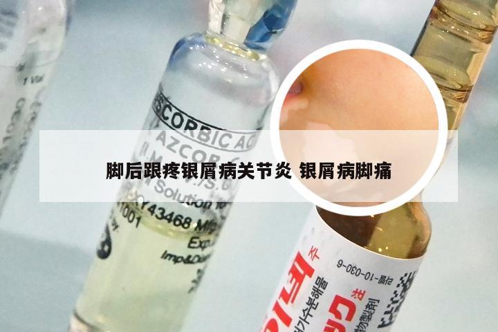 脚后跟疼银屑病关节炎 银屑病脚痛