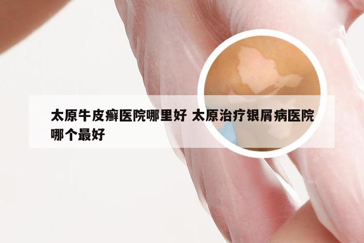太原牛皮癣医院哪里好 太原治疗银屑病医院哪个最好