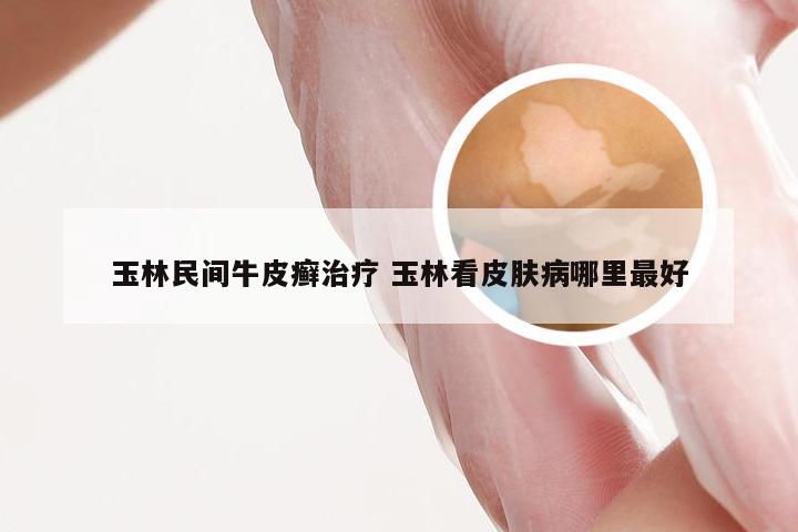 玉林民间牛皮癣治疗 玉林看皮肤病哪里最好