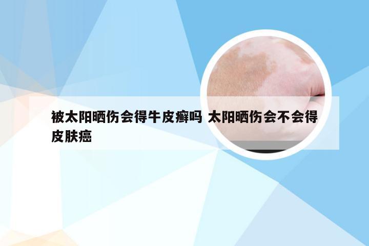 被太阳晒伤会得牛皮癣吗 太阳晒伤会不会得皮肤癌