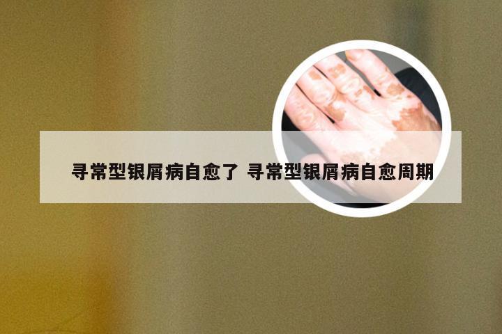 寻常型银屑病自愈了 寻常型银屑病自愈周期