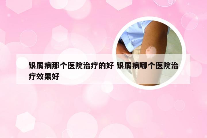 银屑病那个医院治疗的好 银屑病哪个医院治疗效果好