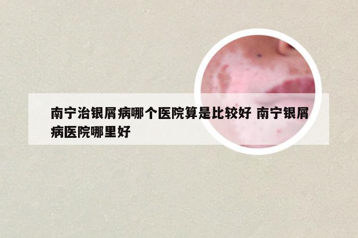 南宁治银屑病哪个医院算是比较好 南宁银屑病医院哪里好