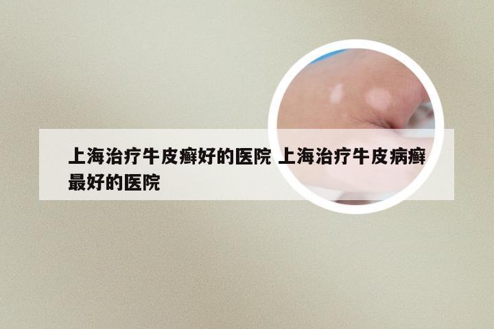 上海治疗牛皮癣好的医院 上海治疗牛皮病癣最好的医院