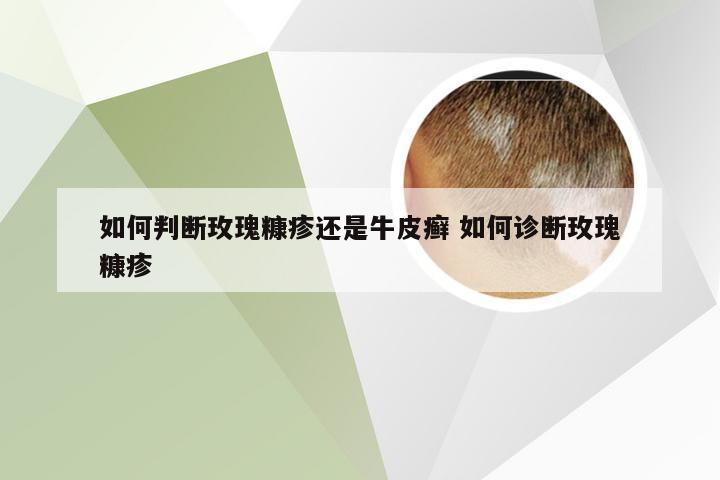 如何判断玫瑰糠疹还是牛皮癣 如何诊断玫瑰糠疹