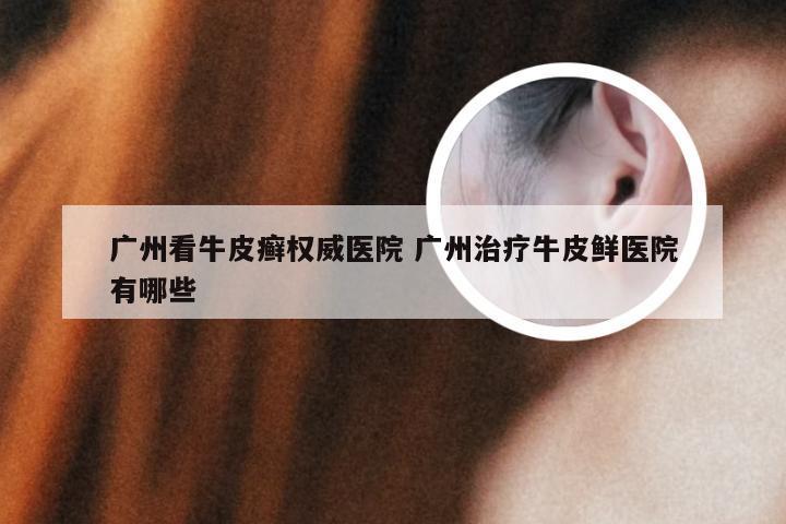 广州看牛皮癣权威医院 广州治疗牛皮鲜医院有哪些