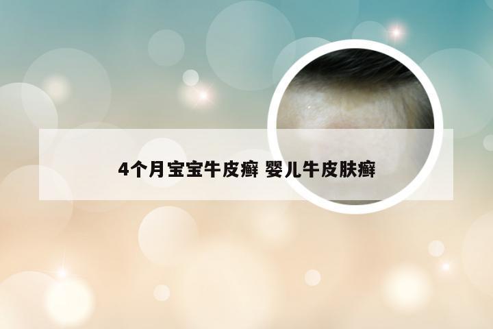4个月宝宝牛皮癣 婴儿牛皮肤癣