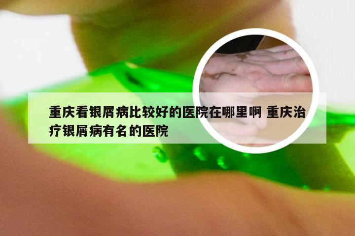 重庆看银屑病比较好的医院在哪里啊 重庆治疗银屑病有名的医院