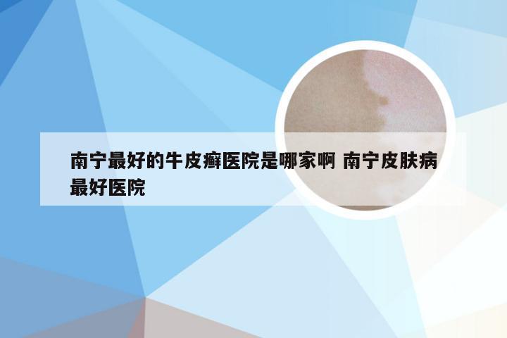 南宁最好的牛皮癣医院是哪家啊 南宁皮肤病最好医院