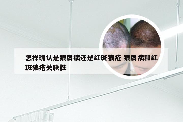 怎样确认是银屑病还是红斑狼疮 银屑病和红斑狼疮关联性