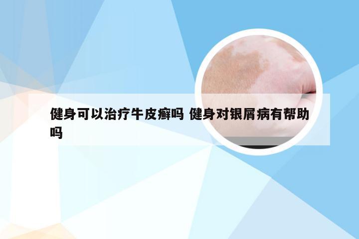 健身可以治疗牛皮癣吗 健身对银屑病有帮助吗
