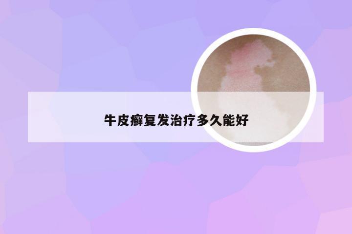 牛皮癣复发治疗多久能好