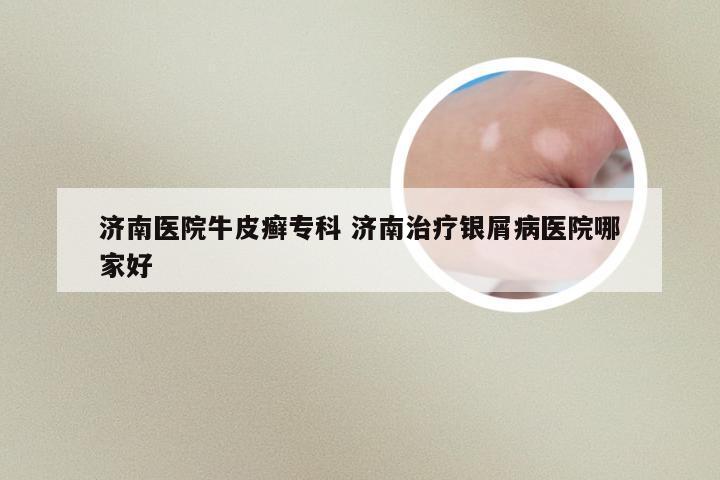 济南医院牛皮癣专科 济南治疗银屑病医院哪家好