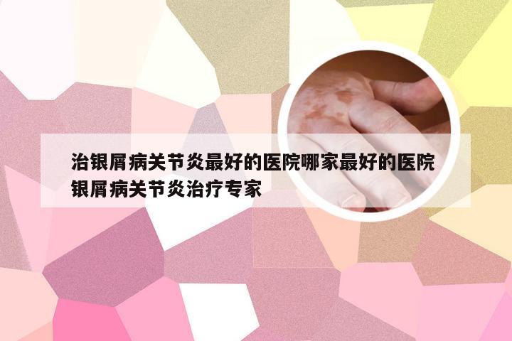 治银屑病关节炎最好的医院哪家最好的医院 银屑病关节炎治疗专家