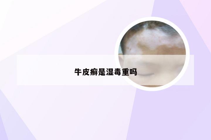 牛皮癣是湿毒重吗
