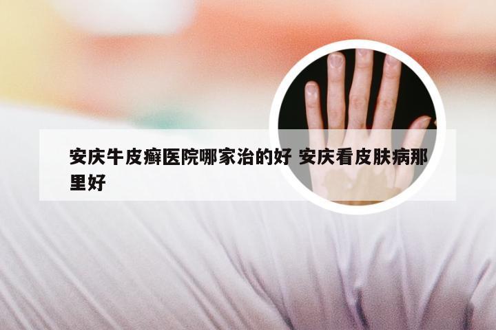 安庆牛皮癣医院哪家治的好 安庆看皮肤病那里好