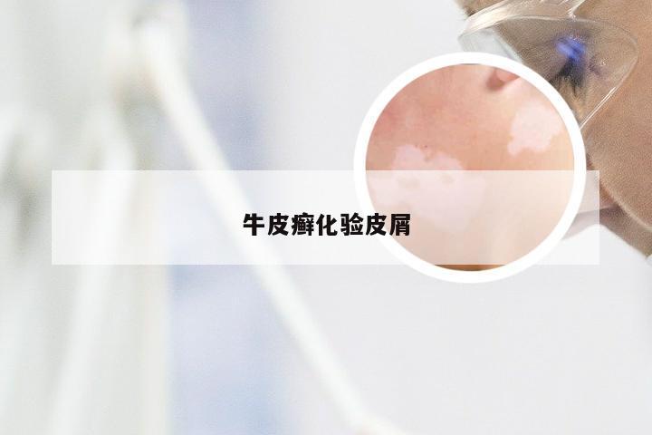 牛皮癣化验皮屑