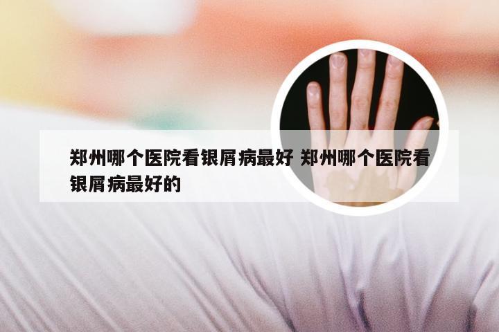 郑州哪个医院看银屑病最好 郑州哪个医院看银屑病最好的