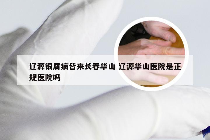 辽源银屑病皆来长春华山 辽源华山医院是正规医院吗