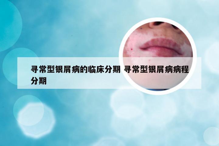 寻常型银屑病的临床分期 寻常型银屑病病程分期