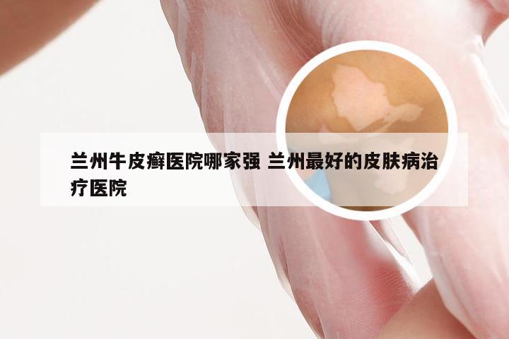 兰州牛皮癣医院哪家强 兰州最好的皮肤病治疗医院