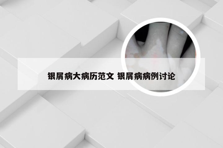 银屑病大病历范文 银屑病病例讨论