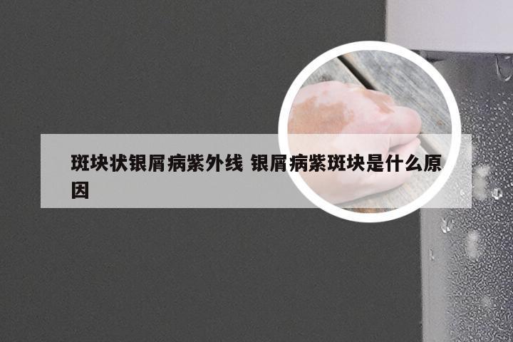 斑块状银屑病紫外线 银屑病紫斑块是什么原因