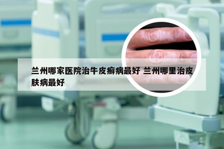 兰州哪家医院治牛皮癣病最好 兰州哪里治皮肤病最好