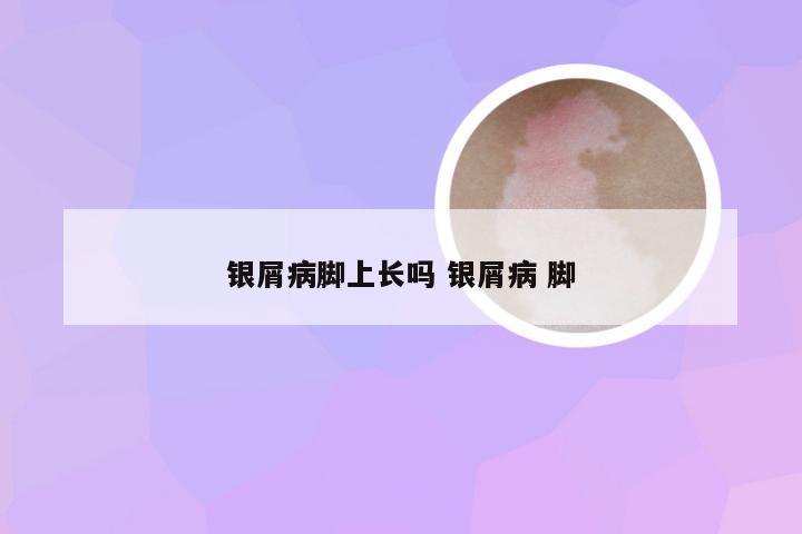 银屑病脚上长吗 银屑病 脚