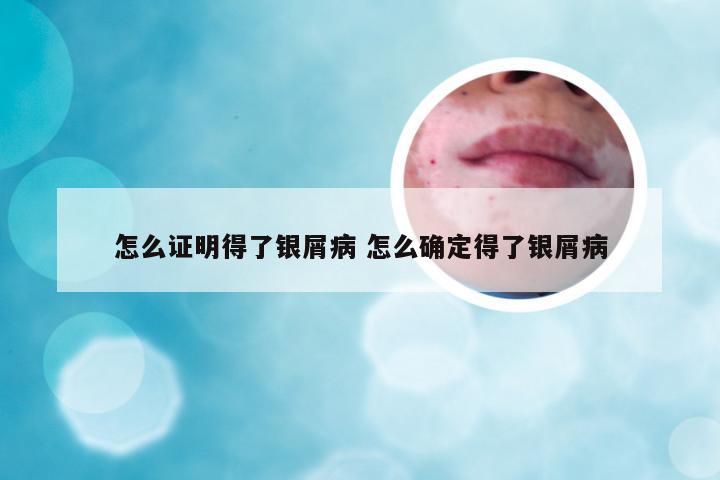 怎么证明得了银屑病 怎么确定得了银屑病