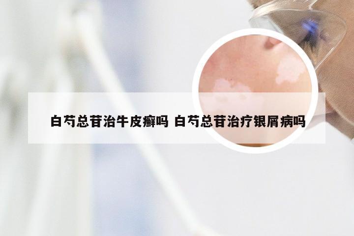 白芍总苷治牛皮癣吗 白芍总苷治疗银屑病吗