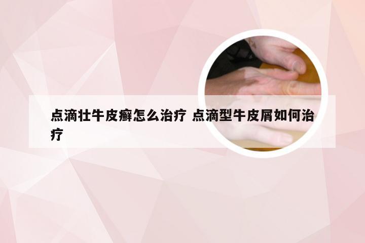 点滴壮牛皮癣怎么治疗 点滴型牛皮屑如何治疗