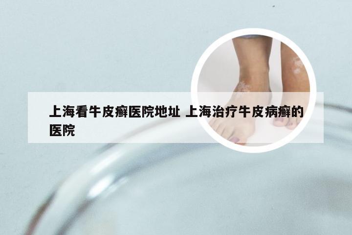 上海看牛皮癣医院地址 上海治疗牛皮病癣的医院