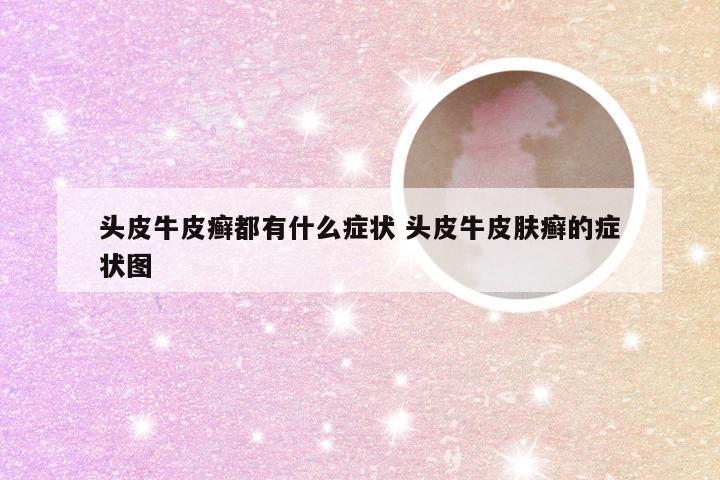头皮牛皮癣都有什么症状 头皮牛皮肤癣的症状图