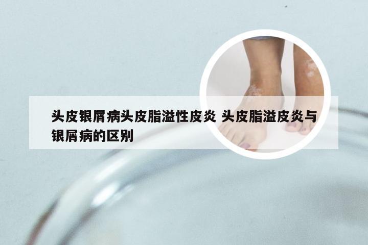头皮银屑病头皮脂溢性皮炎 头皮脂溢皮炎与银屑病的区别