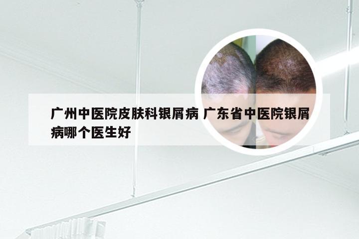 广州中医院皮肤科银屑病 广东省中医院银屑病哪个医生好
