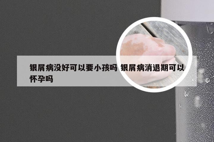 银屑病没好可以要小孩吗 银屑病消退期可以怀孕吗