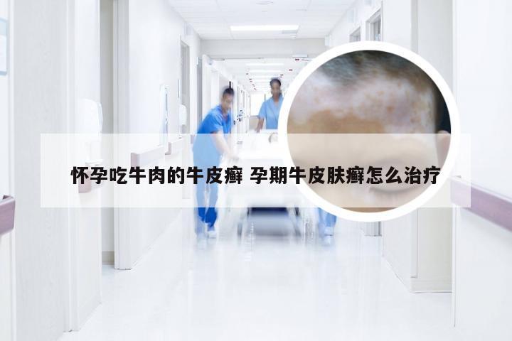 怀孕吃牛肉的牛皮癣 孕期牛皮肤癣怎么治疗