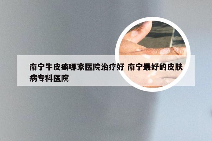 南宁牛皮癣哪家医院治疗好 南宁最好的皮肤病专科医院